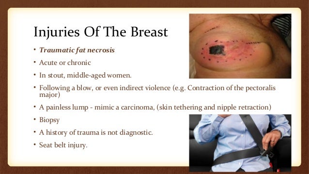 cysts in breast from trauma Cysts in breast from trauma